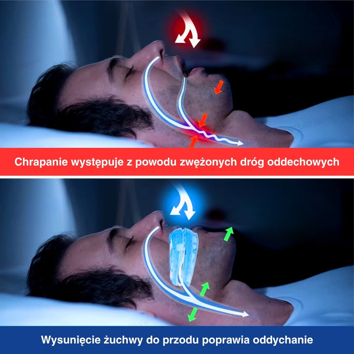 Regulowany Ustnik Przeciw Chrapaniu z Mechanizmem Śrubowym – Wygodne Dostosowanie dla Lepszej Jakości Snu 3